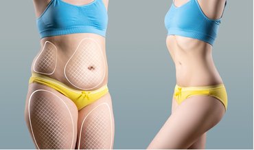tummy-tuck-cellulite-removal-womans-body-before-and-after-liposuction-on-gray-background.jpg_s=1024x1024&w=is&k=20&c=Vq70cZZm0AAdHv8R2mZn4hJot532ym7xziSrltjS0bg=